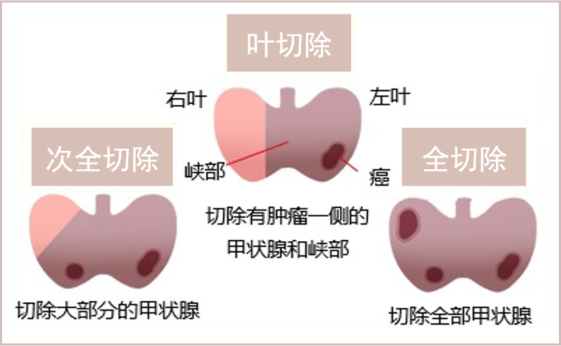 甲状腺12.png