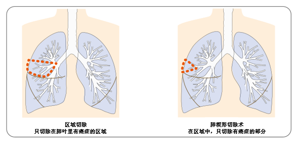 /images/2020/05/21/肺癌 缩小手术.png 肺癌 缩小手术.png